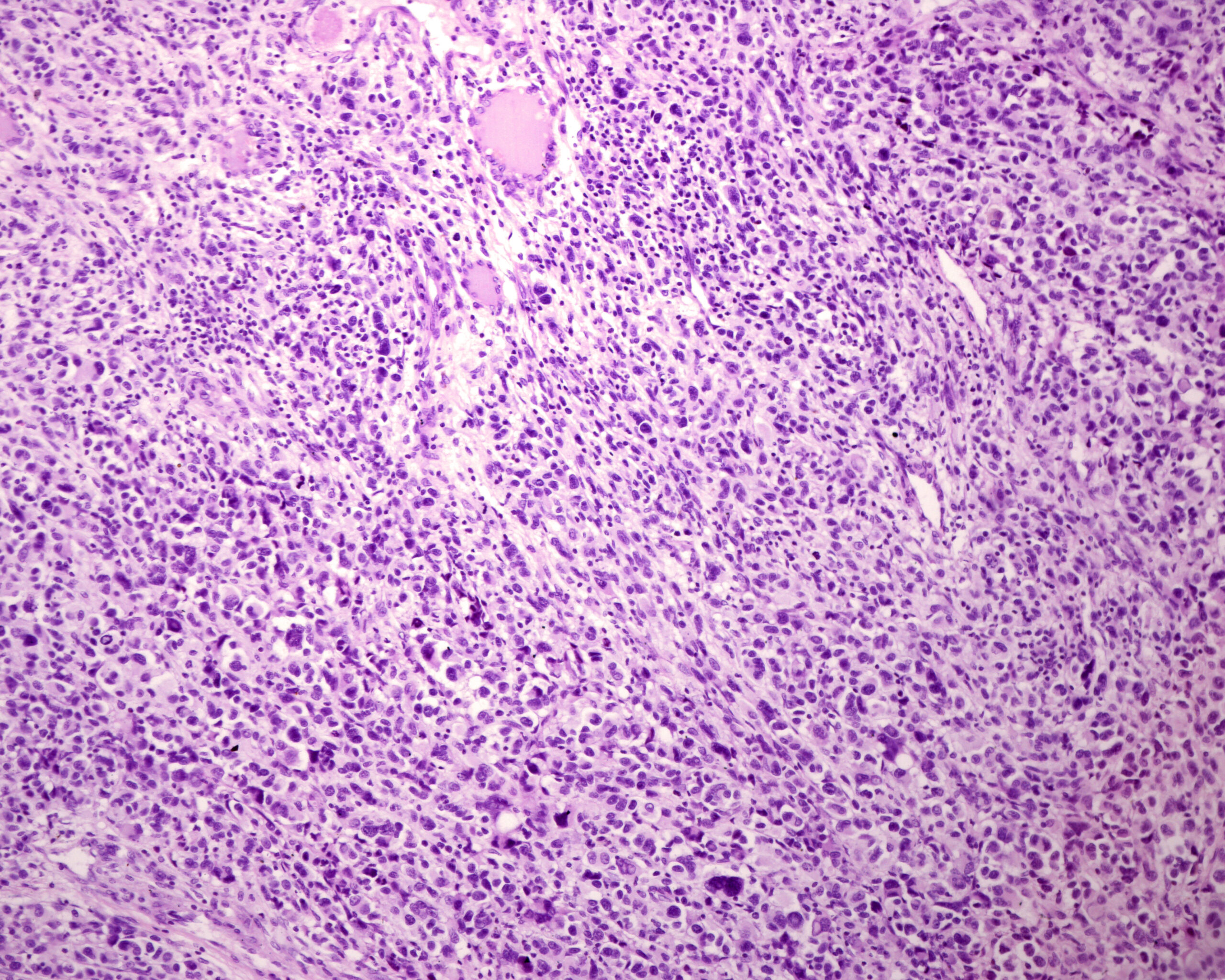Human skin. Pleomorphic sarcoma Human skin. Pleomorphic sarcoma